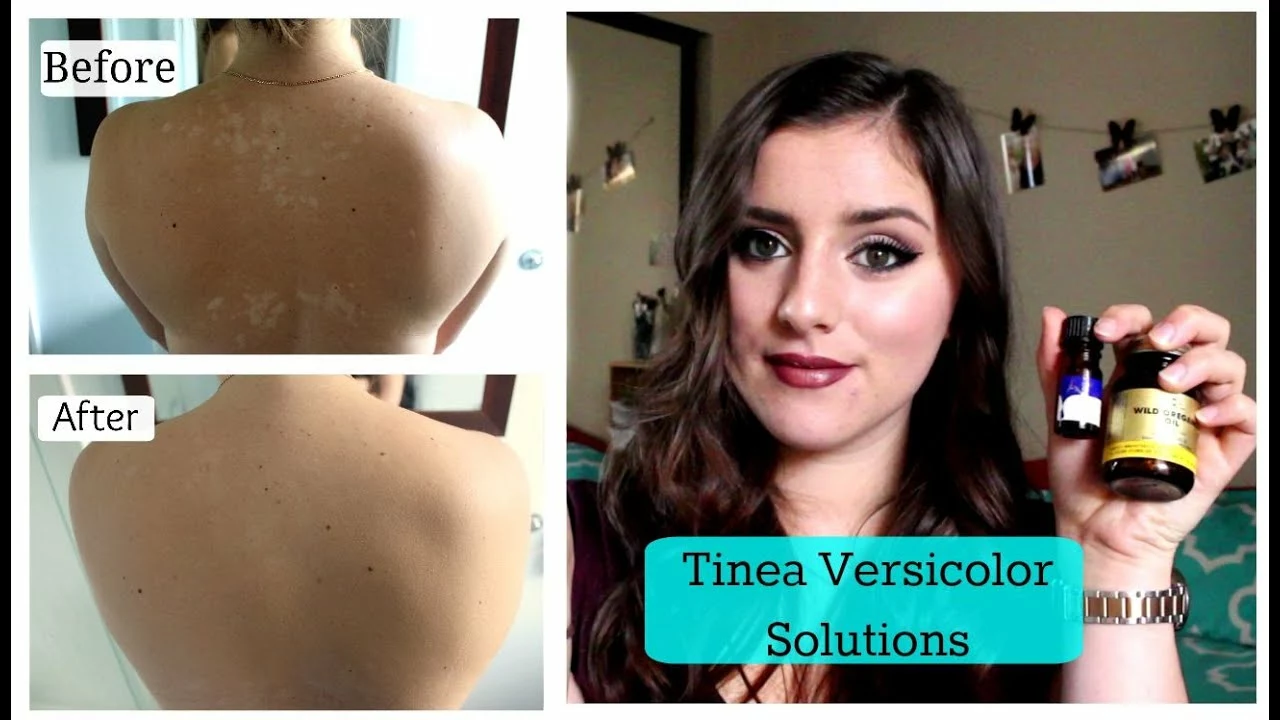 Hur man behandlar Tinea Versicolor på huvudet: Tips och produktrekommendationer